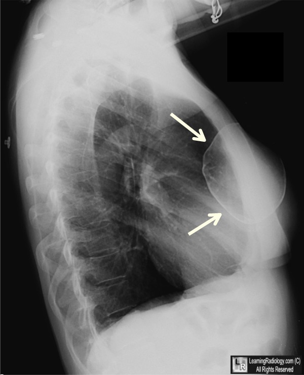 calcified breast implant